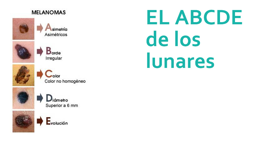 Lunares como se controlan?