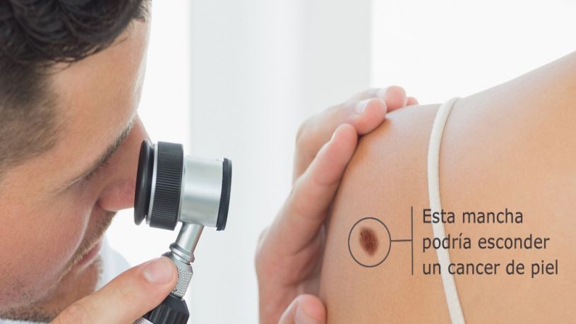 Cncer de piel. Melanoma y no melanoma