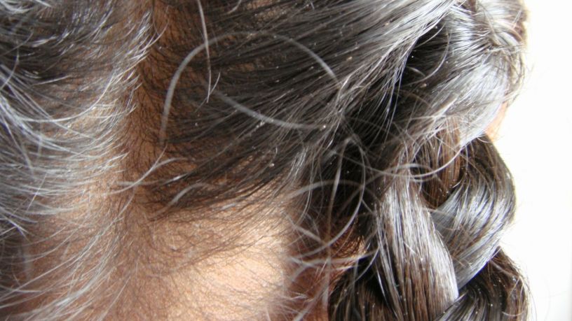 Pediculosis