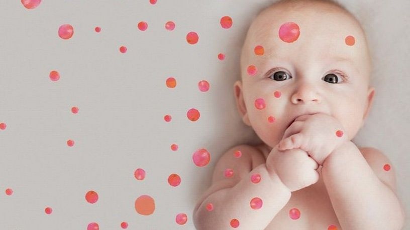 Hemangiomas y malformaciones vasculares