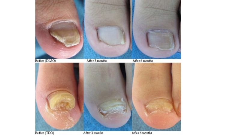 Tratamiento de Onicomicosis 