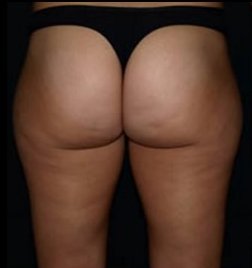 Antes